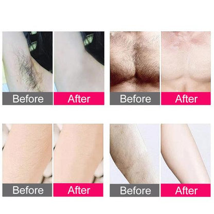 Professional At Home Hair Removal Laser Device
