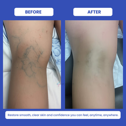 At Home Varicose Vein Remover Laser Pen